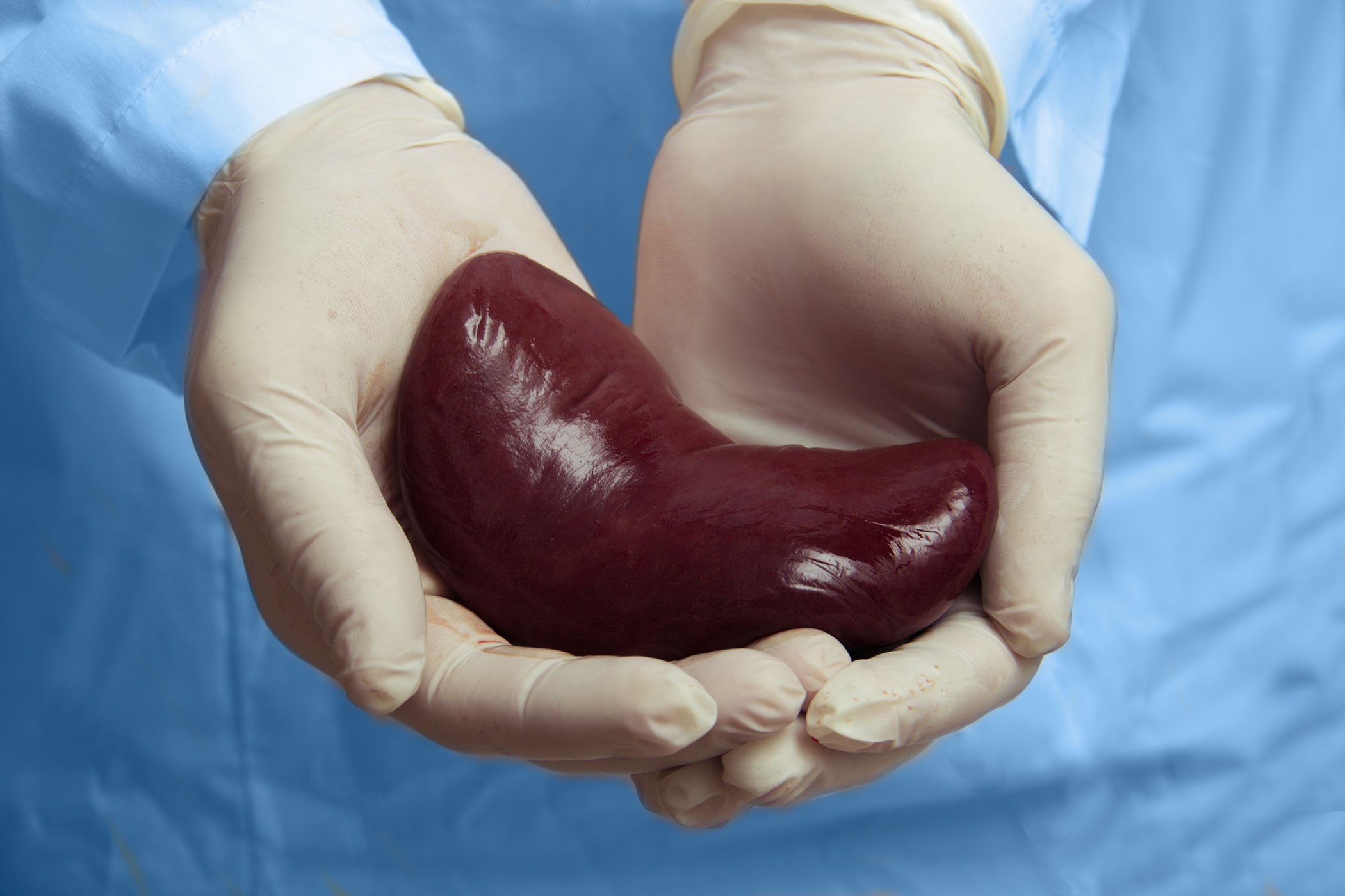 Kidney Transplant